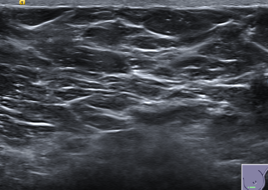 Breast ultrasound with AI lesion annotation